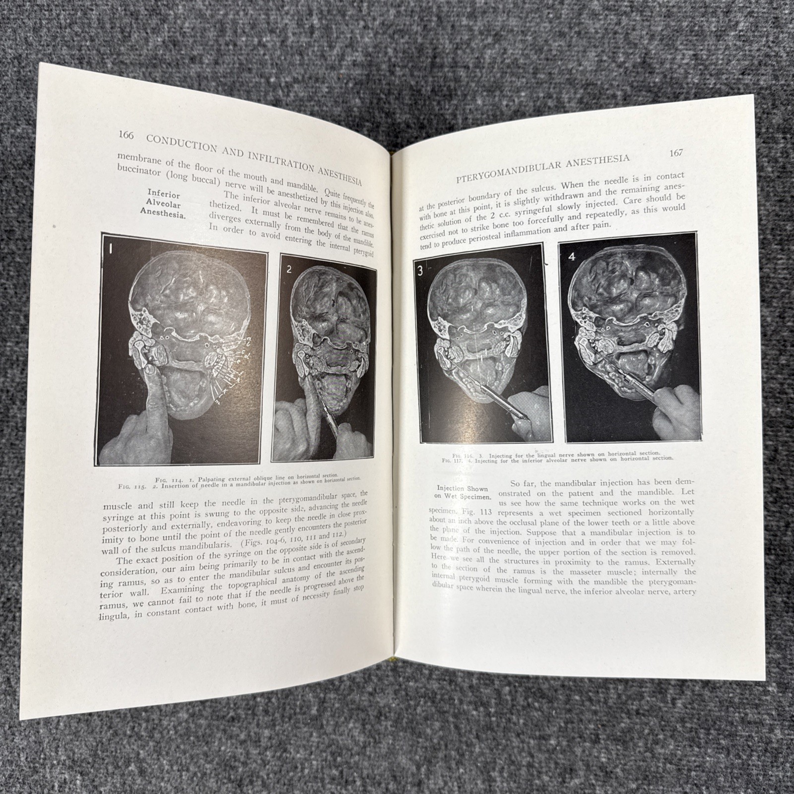 Conduction Infiltration General Anesthesia Dentistry 1943 4th Nevin & Puterbaugh