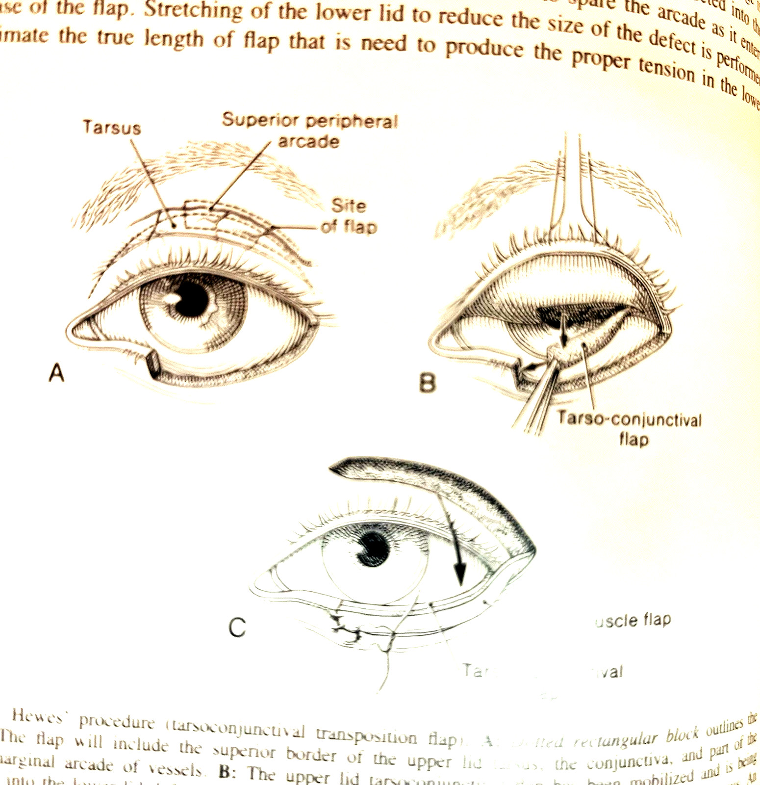 Vintage Oculoplastic Surgery Second Edition Book Hardcover Raven Press 1987