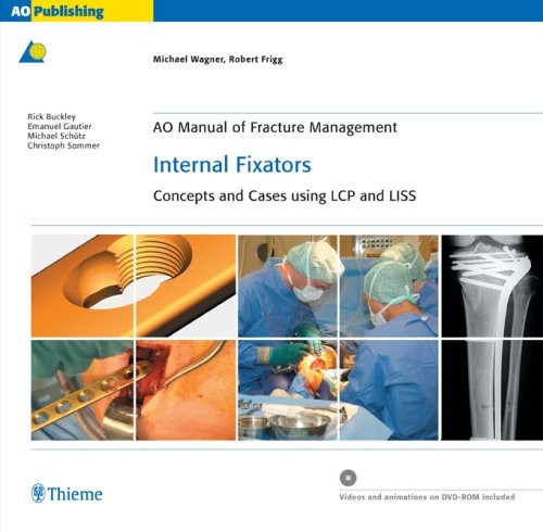 Internal Fixators: Concepts and Cases Using Lcp and Liss (Ao Manual of Fract…